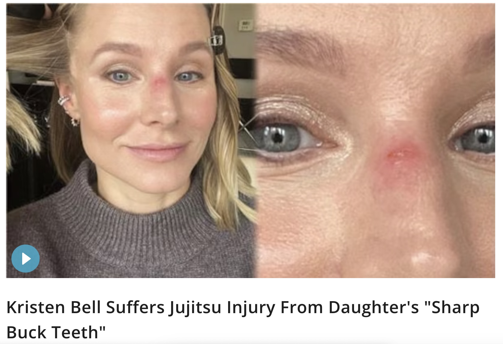 kristen bell broken nose - Kristen Bell Suffers Jujitsu Injury From Daughter's "Sharp Buck Teeth"